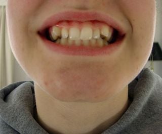 Braces-before